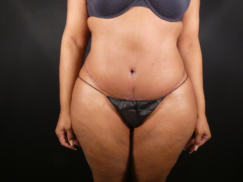 Tummy Tuck Before & After Image