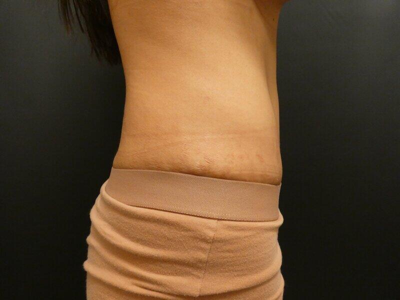 Tummy Tuck Before & After Image