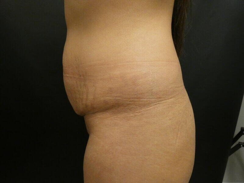 Tummy Tuck Before & After Image