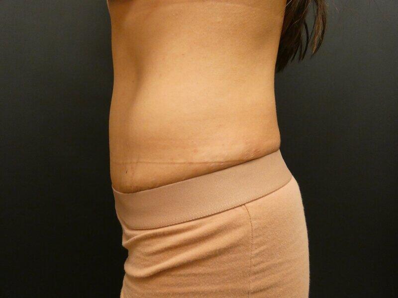 Tummy Tuck Before & After Image