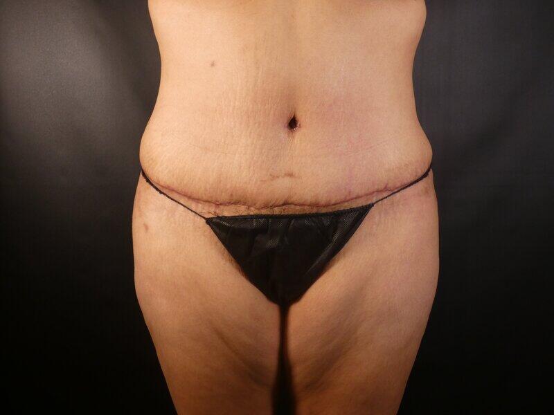 Tummy Tuck Before & After Image