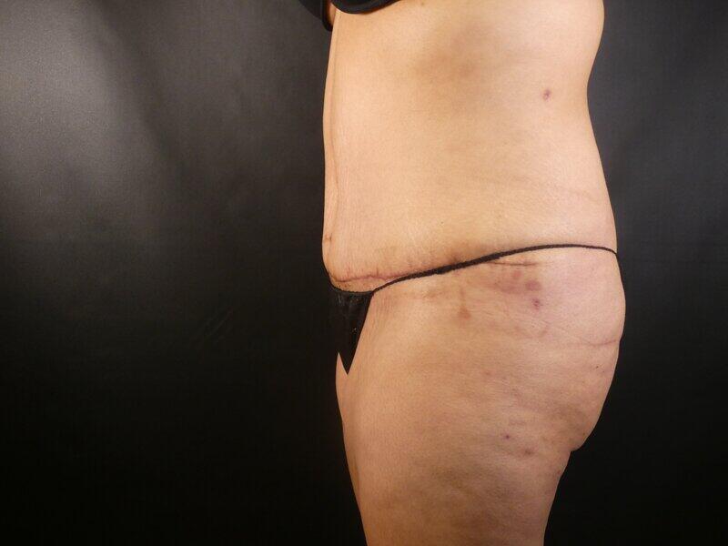 Tummy Tuck Before & After Image