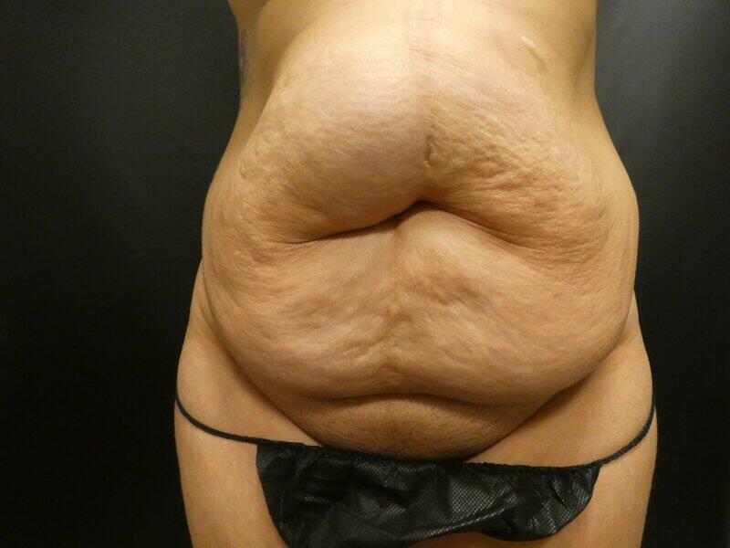 Tummy Tuck Before & After Image