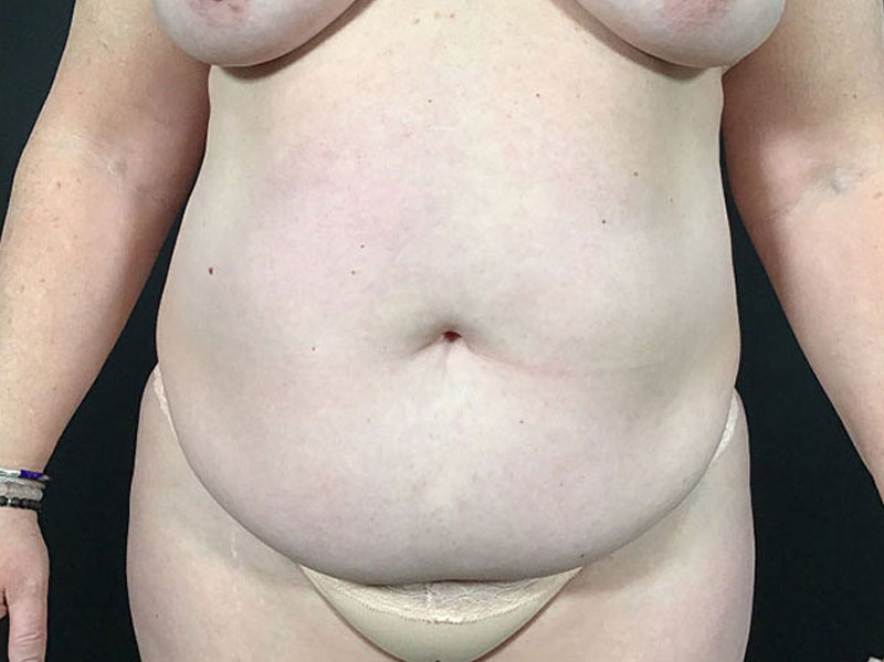 Tummy Tuck Before & After Image