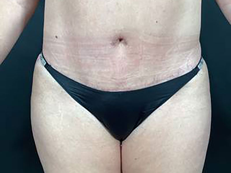 Tummy Tuck Before & After Image