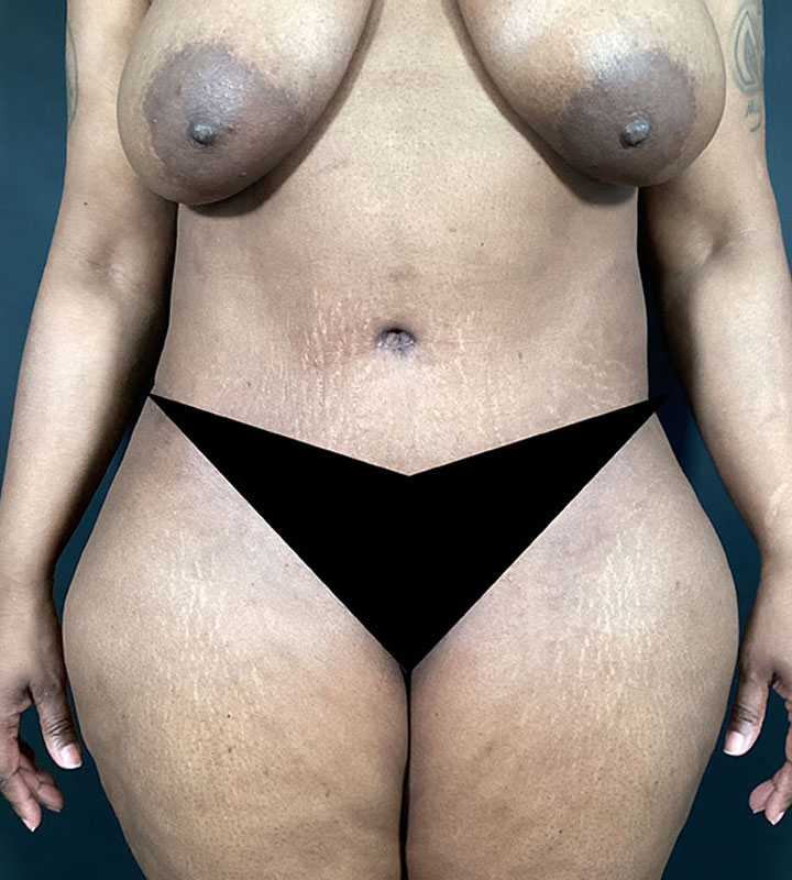 Tummy Tuck Before & After Image