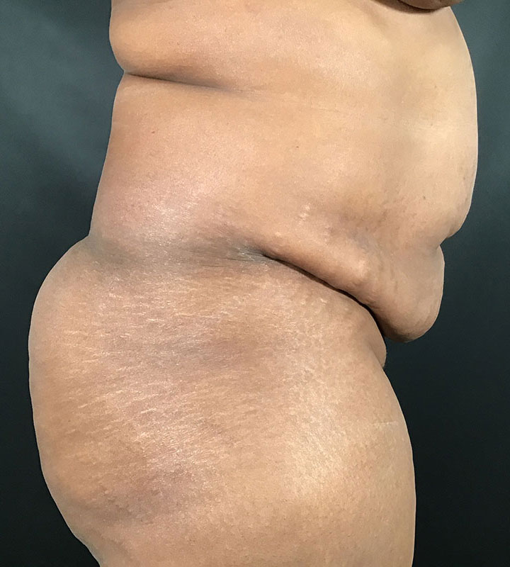 Tummy Tuck Before & After Image