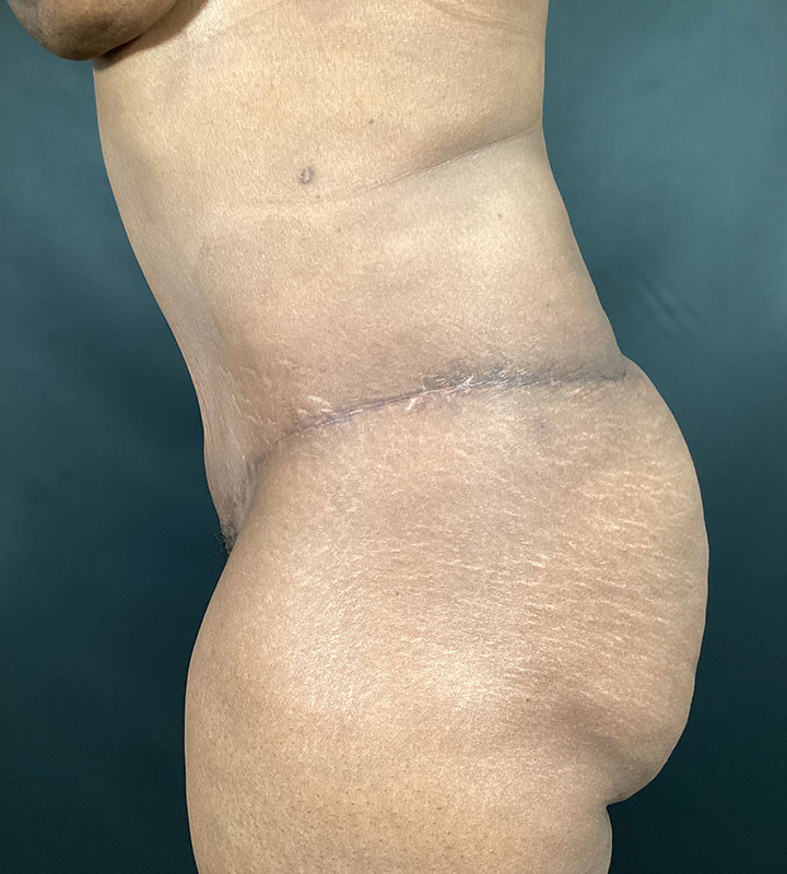 Tummy Tuck Before & After Image