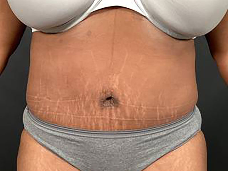Tighten Loose Skin with a Tummy Tuck - n Chicago, Illinois