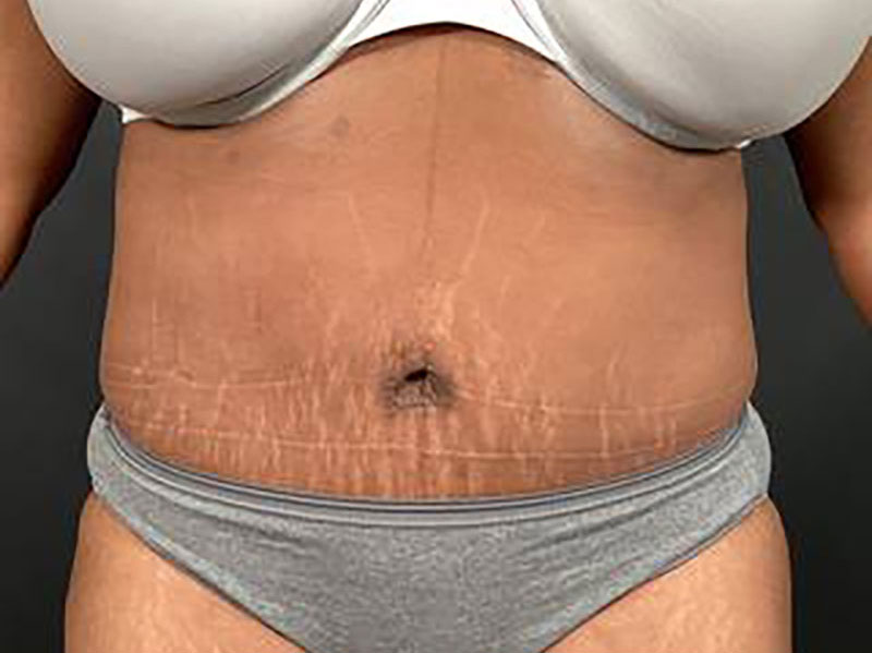 Tummy Tuck Before & After Image