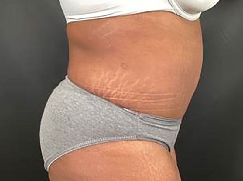 Tummy Tuck Before & After Image