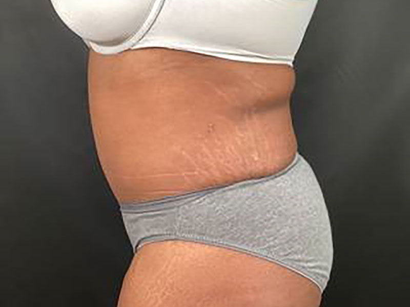 Tummy Tuck Before & After Image