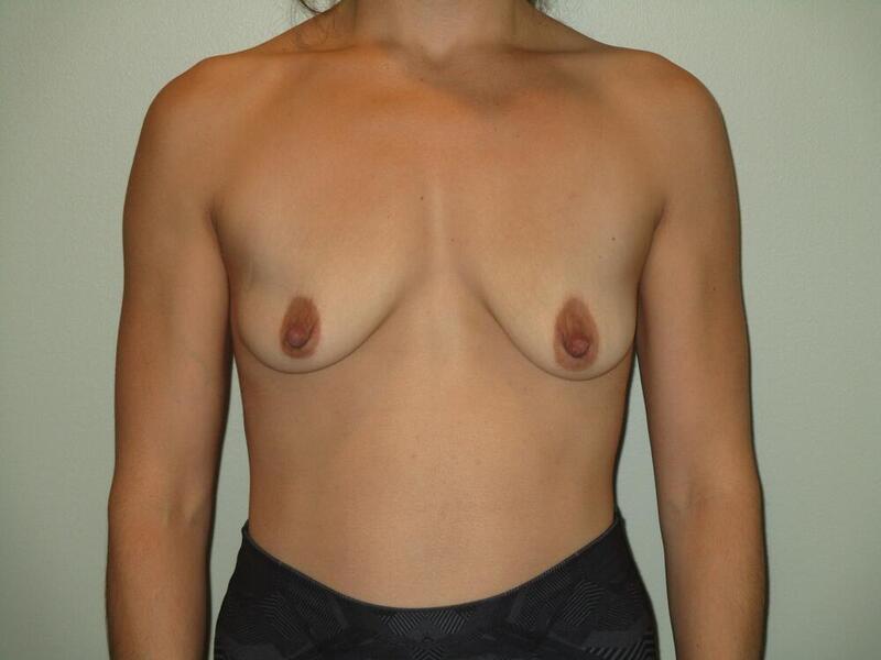 Breast Asymmetry Correction Before & After Image