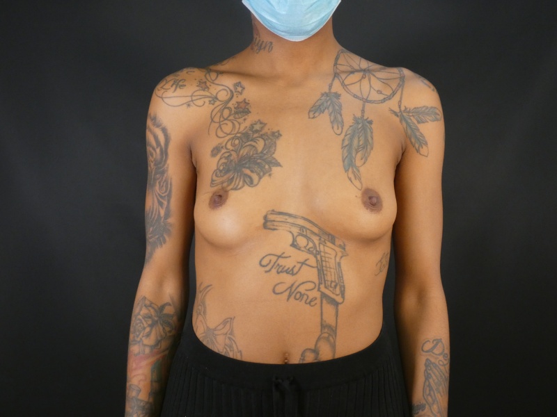 Breast Asymmetry Correction Before & After Image