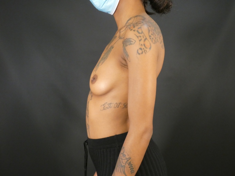 Breast Asymmetry Correction Before & After Image