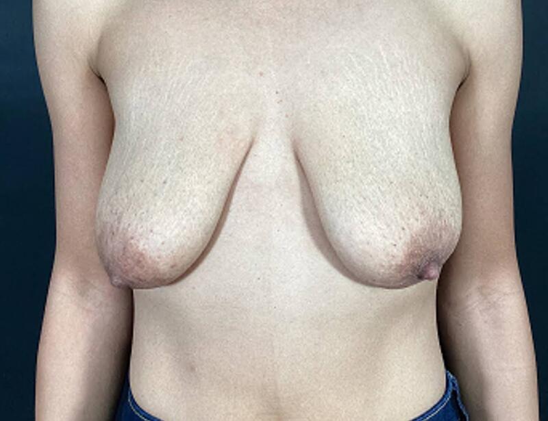 Breast Augmentation with Lift Before & After Image