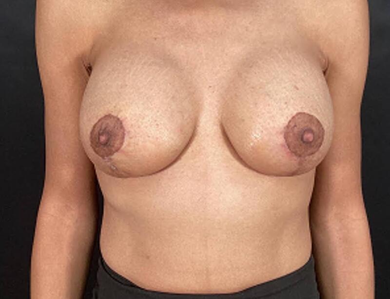 Breast Augmentation with Lift Before & After Image