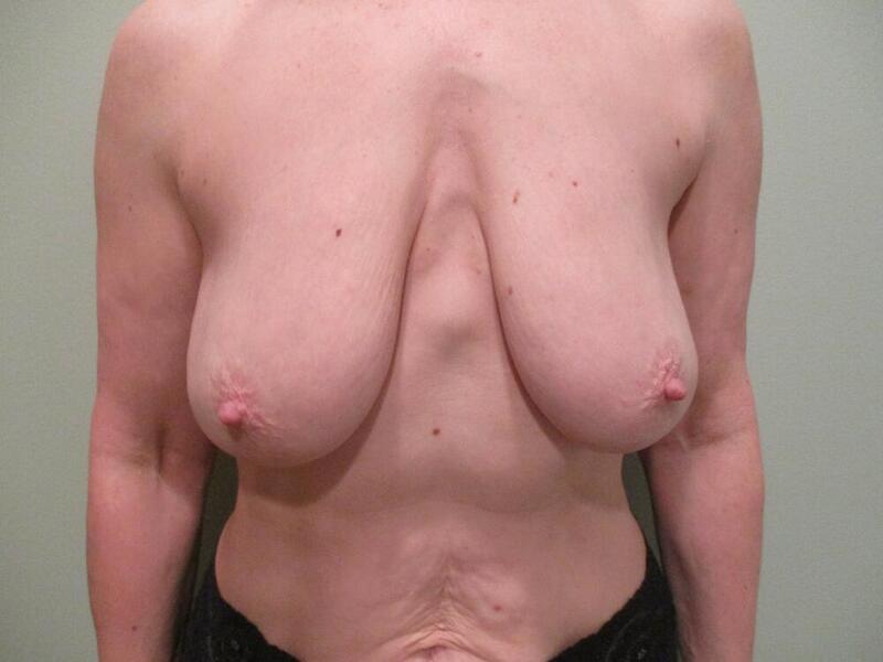 Breast Augmentation with Lift Before & After Image