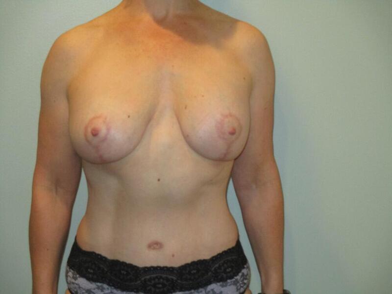 Breast Augmentation with Lift Before & After Image