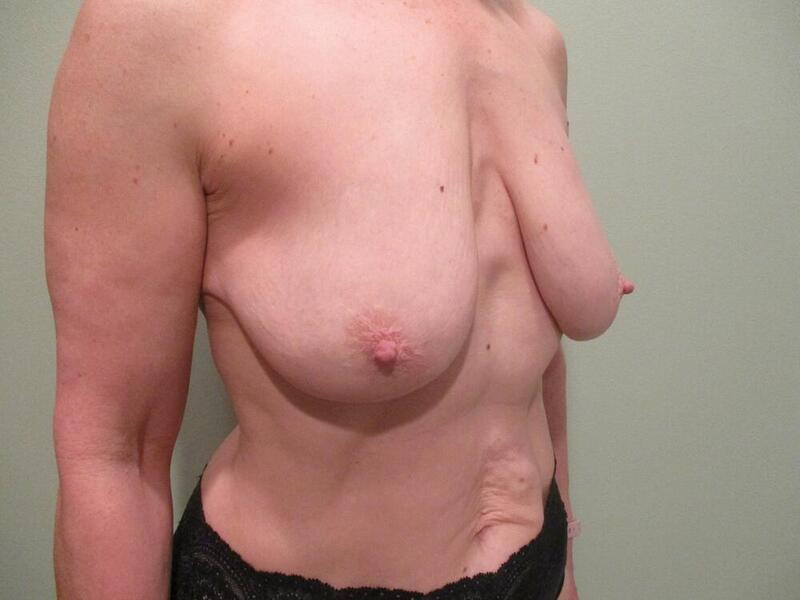 Breast Augmentation with Lift Before & After Image