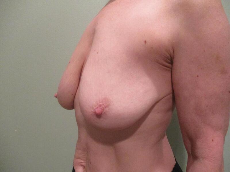 Breast Augmentation with Lift Before & After Image