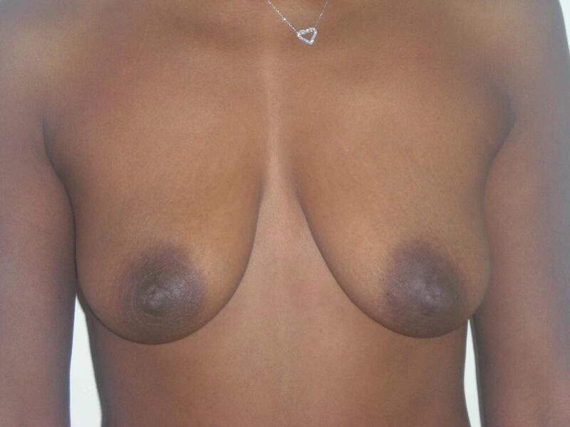 Breast Augmentation with Lift Before & After Image