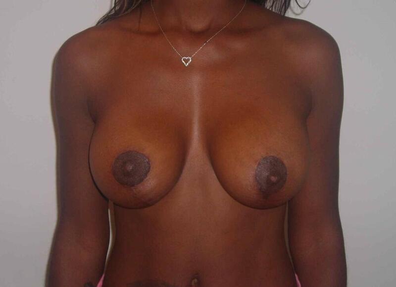 Breast Augmentation with Lift Before & After Image