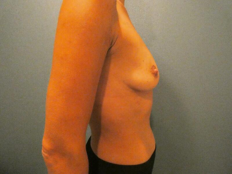 Breast Augmentation with Lift Before & After Image