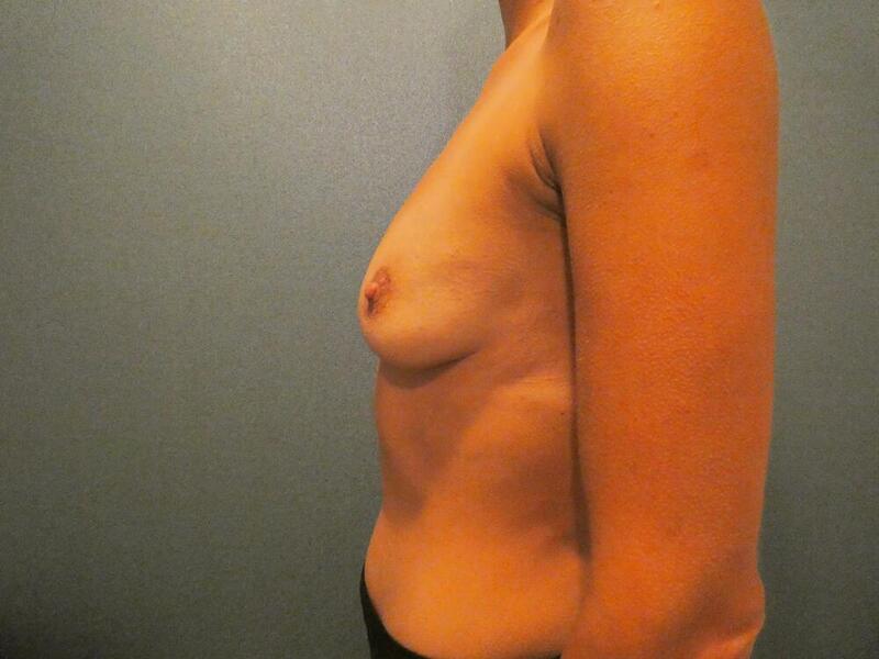 Breast Augmentation with Lift Before & After Image