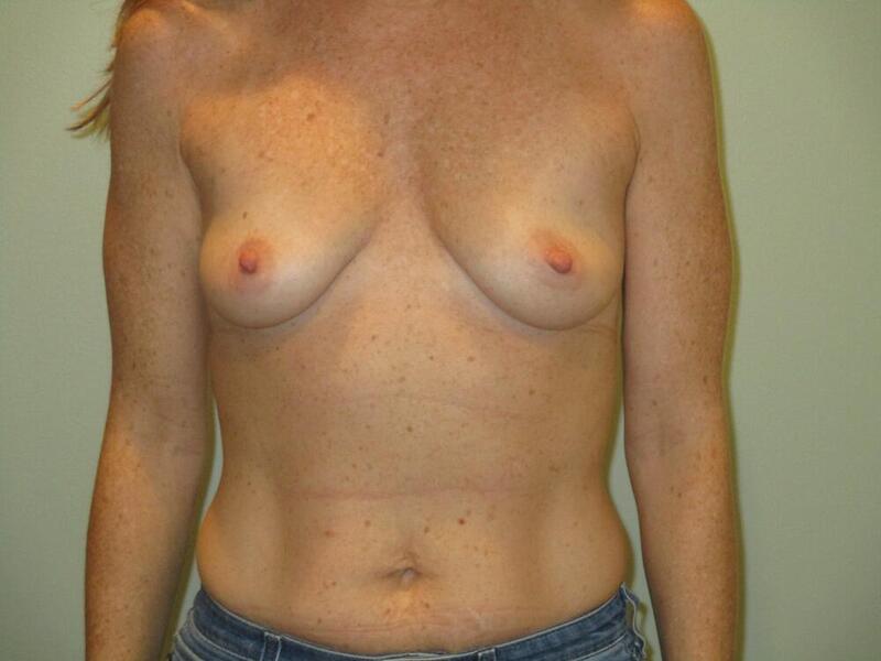 Breast Augmentation with Lift Before & After Image