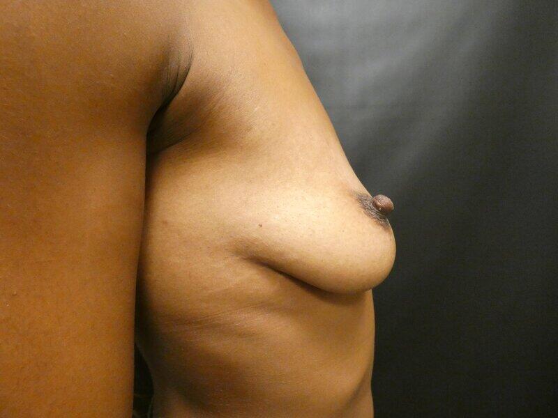 Breast Augmentation with Lift Before & After Image