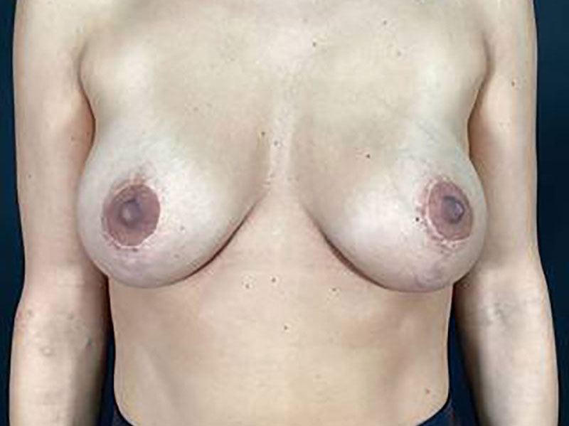 Breast Augmentation with Lift Before & After Image