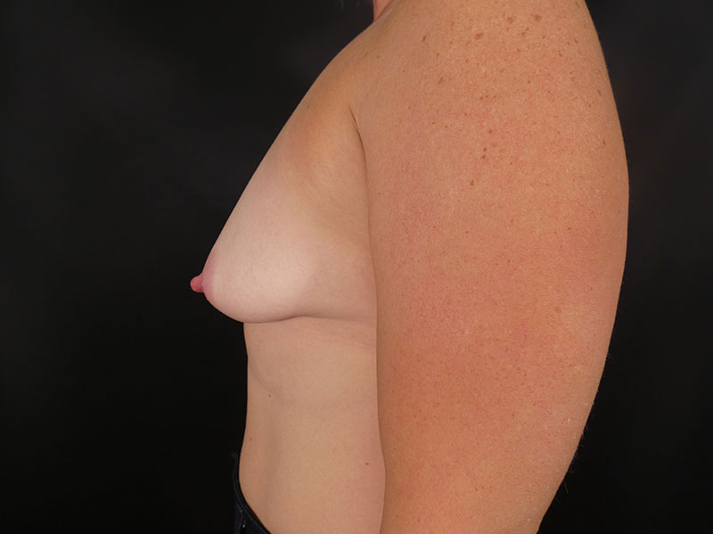 Breast Augmentation with Lift Before & After Image