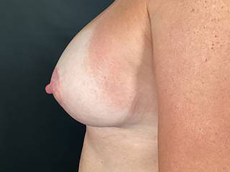 Breast Augmentation with Lift Before & After Image