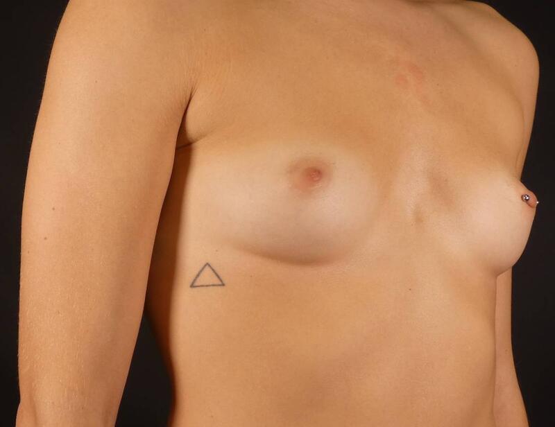 Breast Augmentation Before & After Image