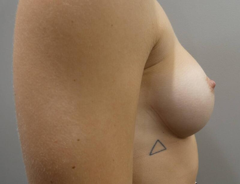 breast augmentation before and afters after photo 3