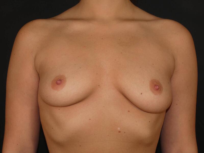 Breast Augmentation Before & After Image