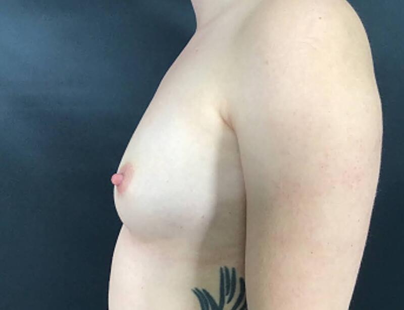 Breast Augmentation Before & After Image