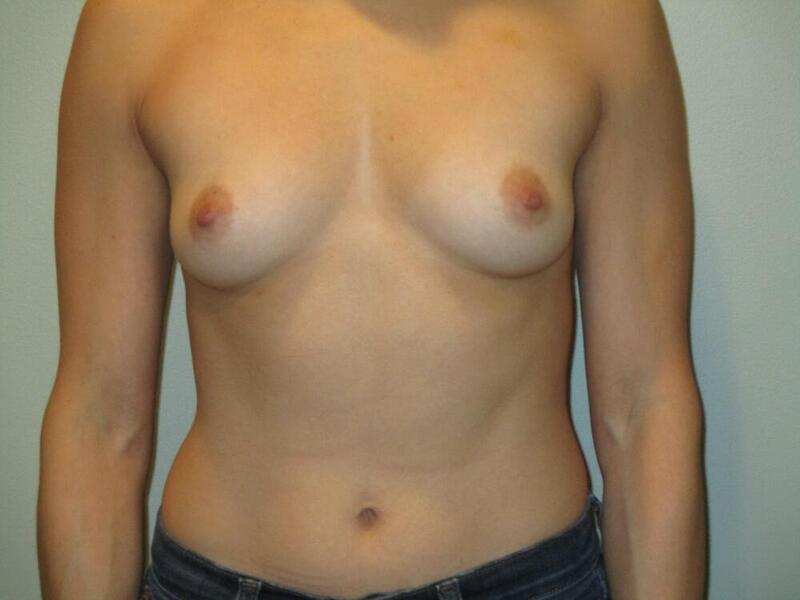 Breast Augmentation Before & After Image