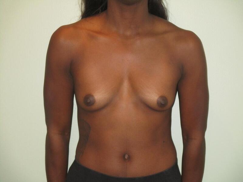 Breast Augmentation Before & After Image