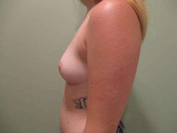 Breast Augmentation Before & After Image