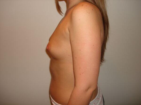 Breast Augmentation Before & After Image