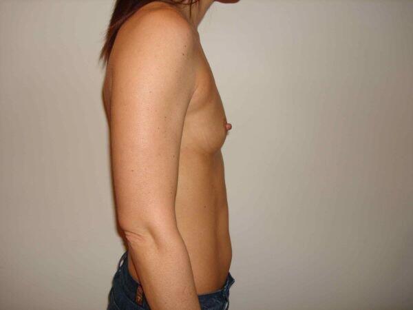 Breast Augmentation Before & After Image