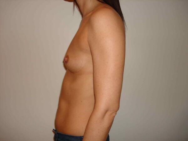 Breast Augmentation Before & After Image