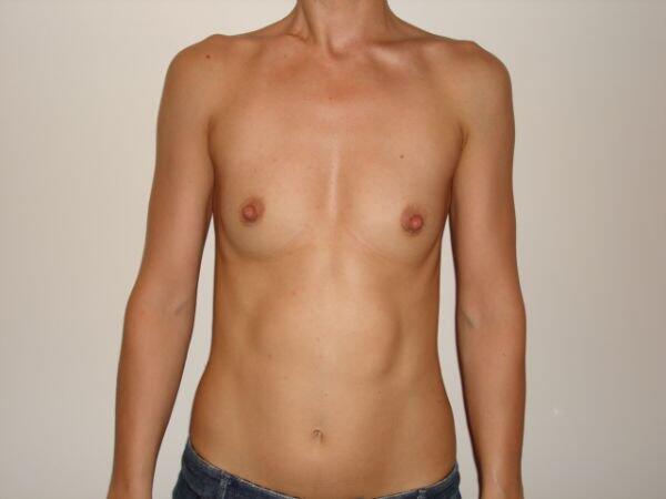 Breast Augmentation Before & After Image