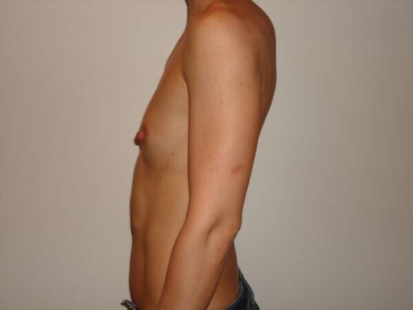 Breast Augmentation Before & After Image