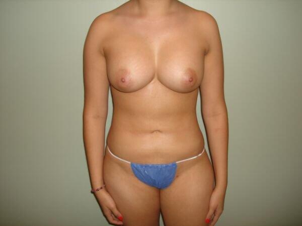 Breast Augmentation Before & After Image