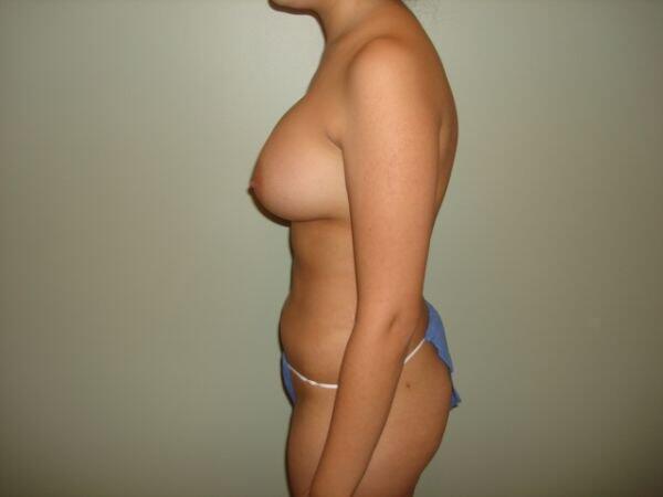 Breast Augmentation Before & After Image