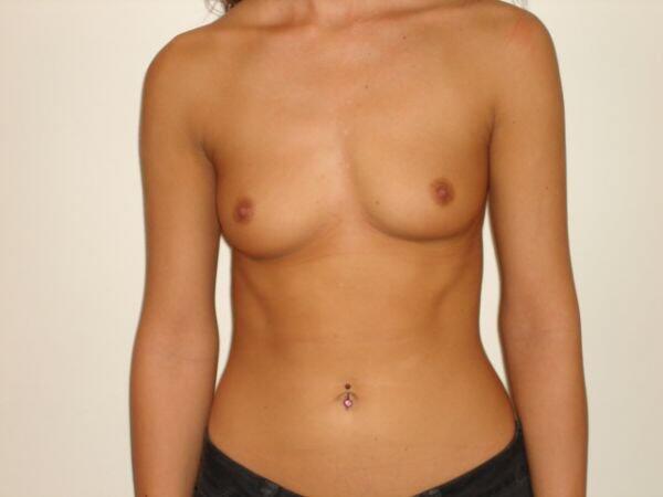 Breast Augmentation Before & After Image