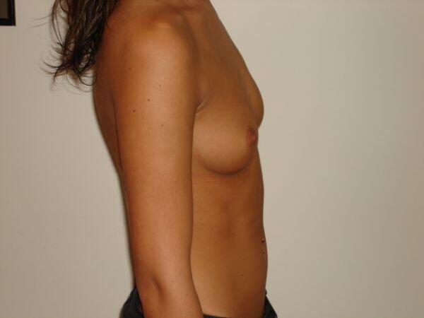 Breast Augmentation Before & After Image